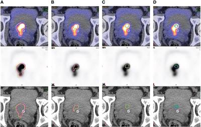 Reliability of gradient-based segmentation for measuring metabolic parameters influenced by uptake time on 18F-PSMA-1007 PET/CT for prostate cancer